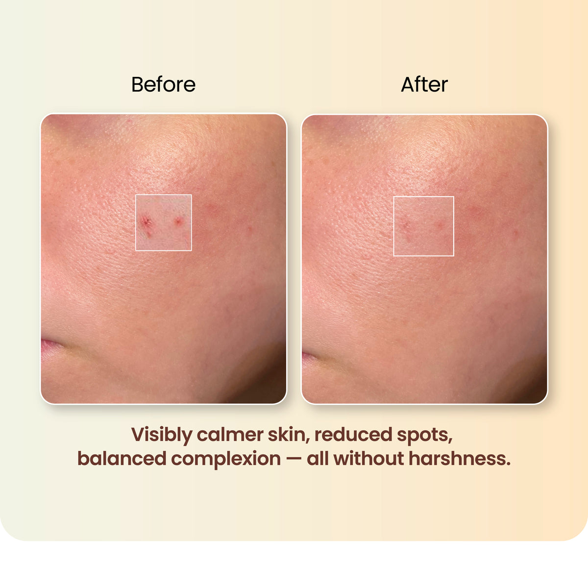 Acne Cleanse & Treat Ritual
