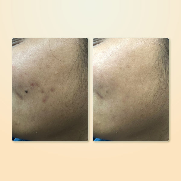 moha: Anti-Acne Foaming Face Wash