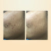 Acne Cleanse & Treat Ritual