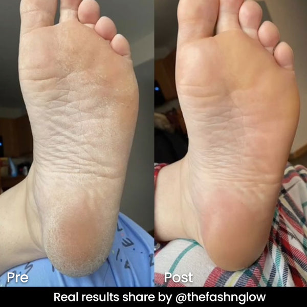 Foot Care Cream for Smooth & Pain Free Feet